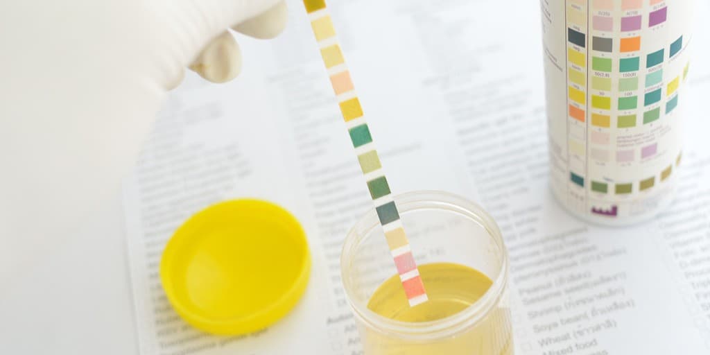 pasma śluzu w moczu